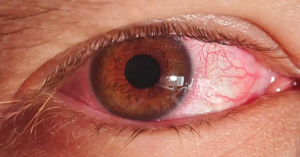 Eye redness (viral pink eye symptom)