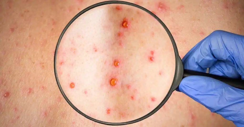 Rubella (German Measles)