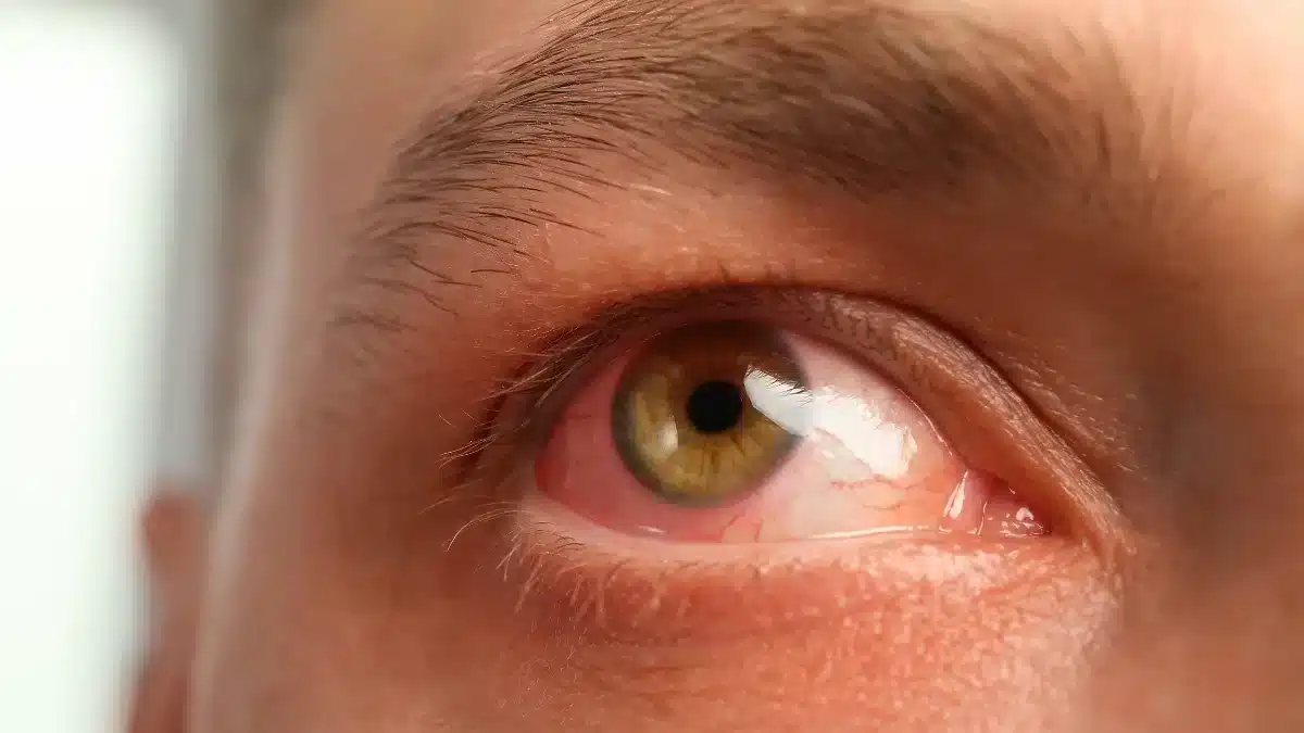 Understanding Antibiotics for Eye Infections