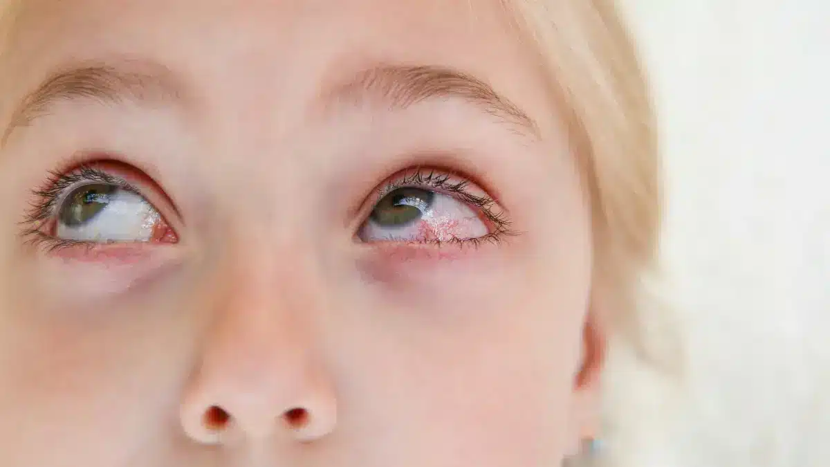 bacterial eye infection