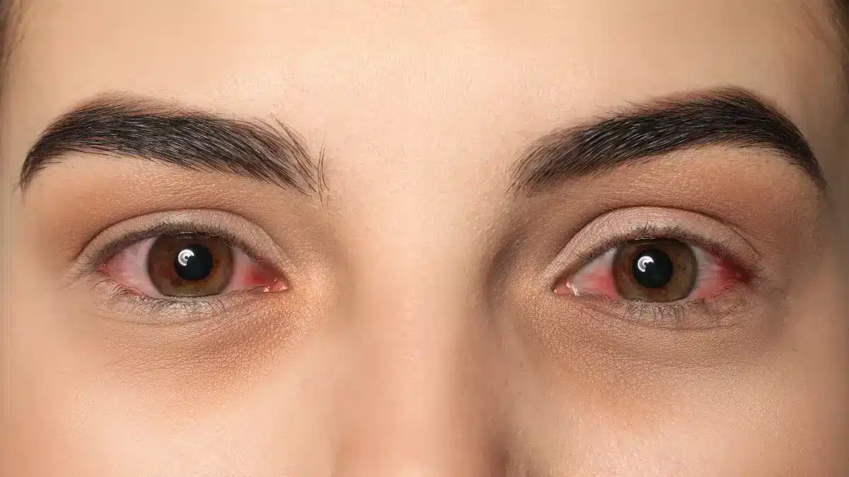 Can Pink Eye Cause Blindness? Exploring the Link Between the Two