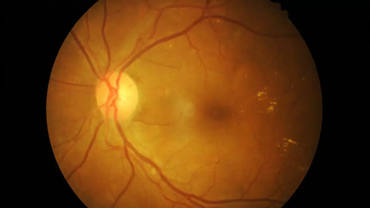 Can Dry Eyes Cause Vitreous Detachment? Get the Answers Here