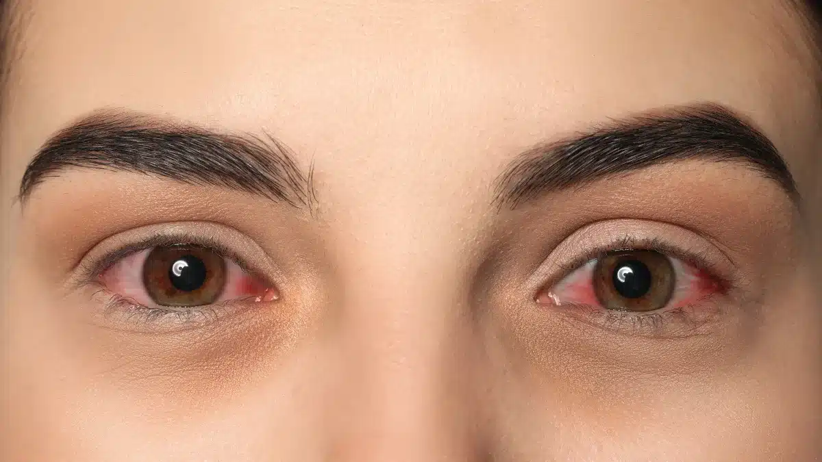 Finding the Right Pink Eye Medicine Understand Your Need