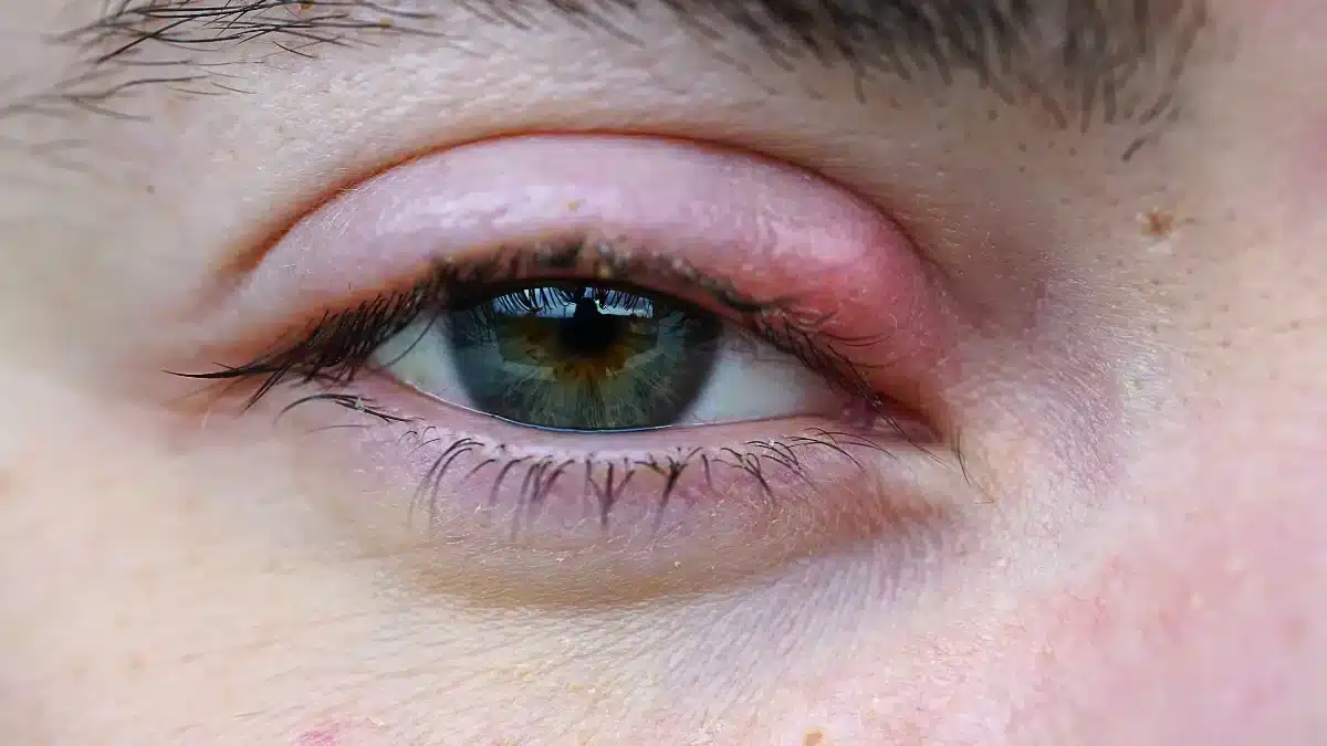 Pink Eye vs Stye Understanding Causes, Symptoms, and Treatment