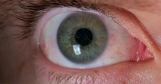 Close-up of eye affected by punctate keratitis