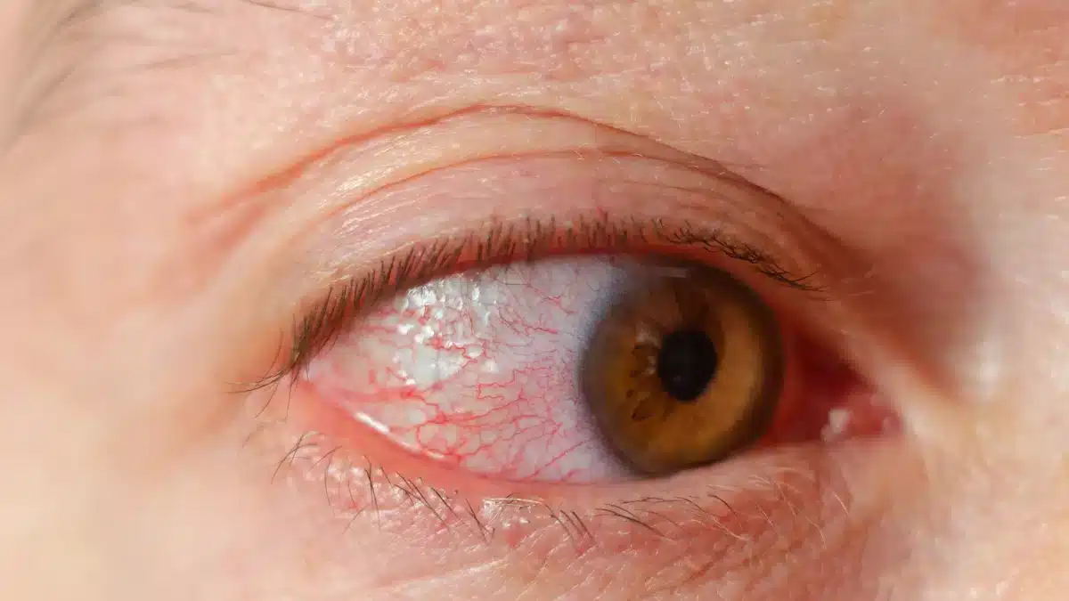 Bacterial Keratitis Causes, Symptoms, and Treatment Options