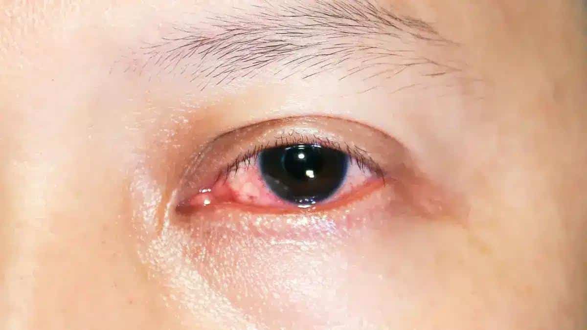 Exploring Keratitis Treatment Options 