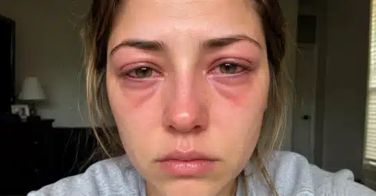 Woman with swollen red eyes caused by allergies
