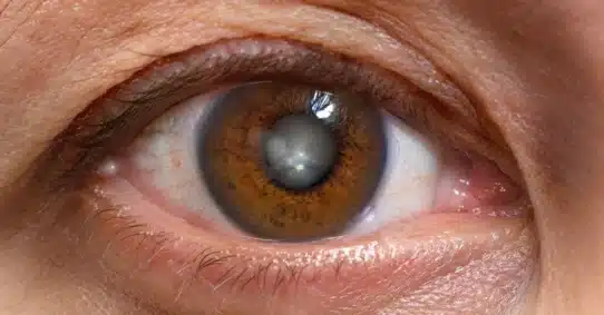 Close-up of eye with posterior polar cataract