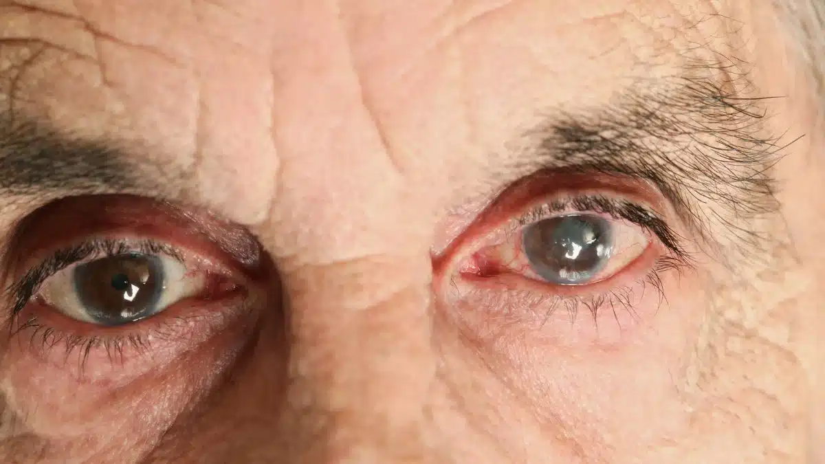 cataract treatment