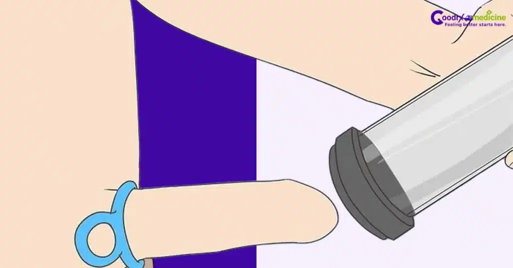 Sliding tension ring from VED tube to penis