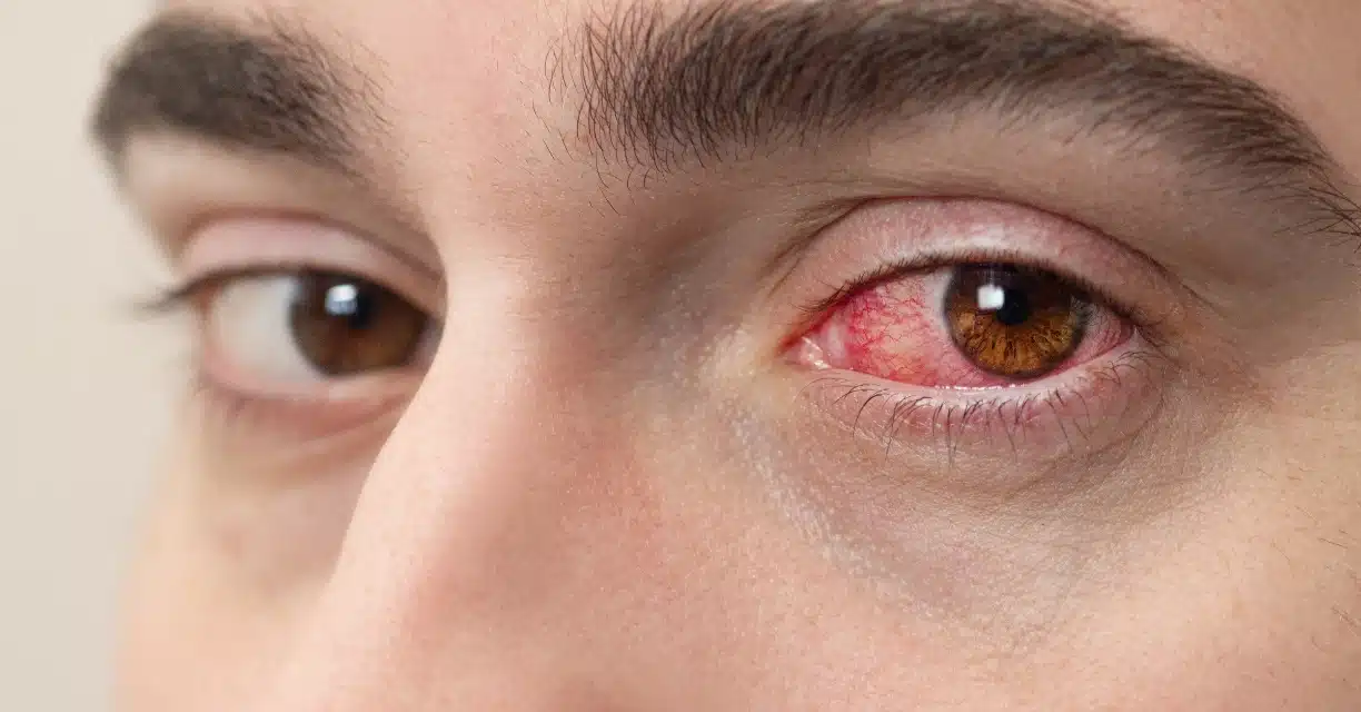Close-up of irritated pink eye and blurred vision risk